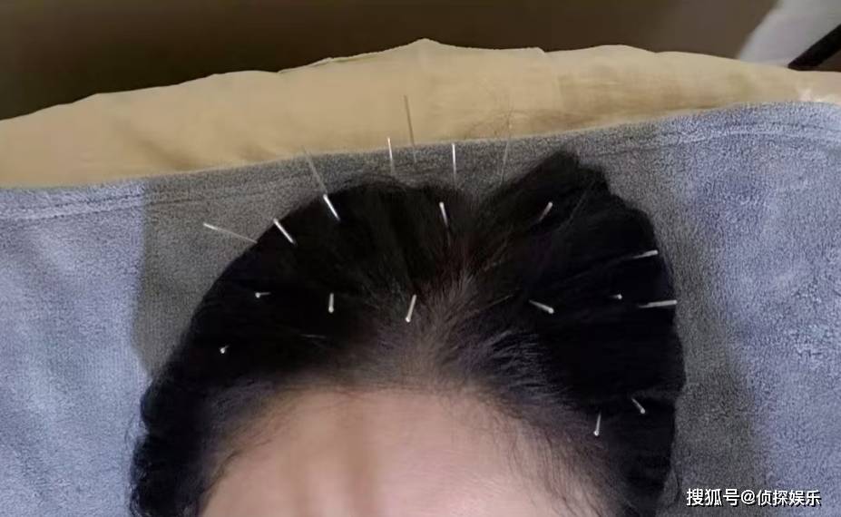 陈乔恩分享针雕保养法，从头到脚密密麻麻扎满针，为冻龄太拼了