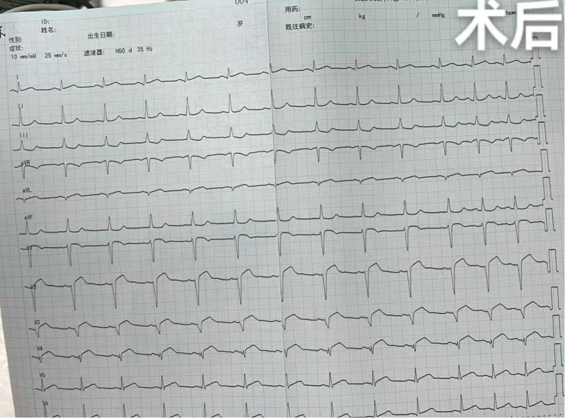 【天眼问医】医院心内科上演“生死时速”抢救生命！医生提醒：胸痛可能是心脏在“报警”(图4)