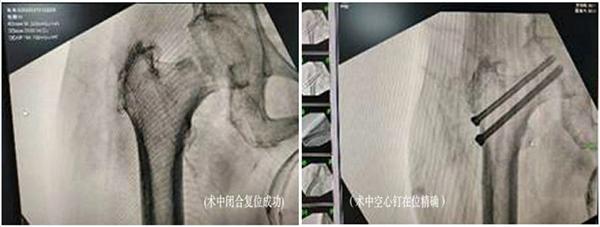 青岛市即墨区人民医院：“螺钉上的芭蕾”