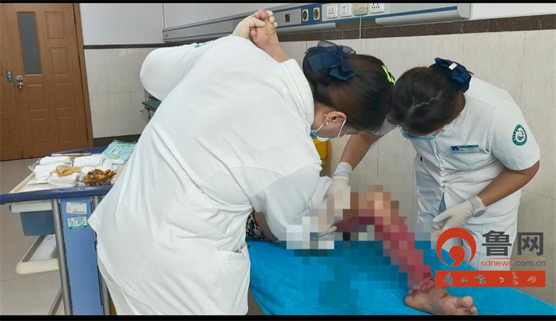 烟台市蓬莱人民医院成功救治一例双下肢烫伤合并感染患者