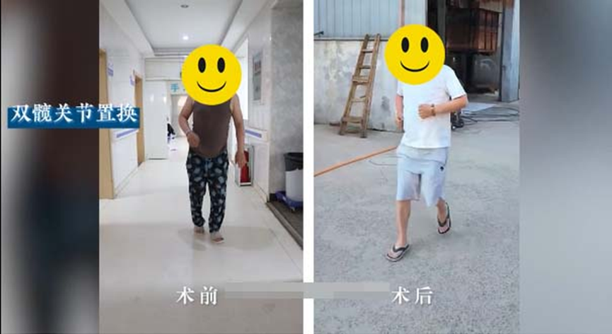30多岁小伙股骨头坏死拄拐多年，天津到济南终找回健康双腿