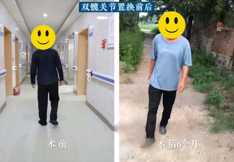 济南关节外科医院专病专治 潍坊五旬大哥重拾健康行走能力