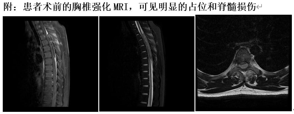 15岁少年突发截瘫，微创骨科急症手术半月助其站立行走