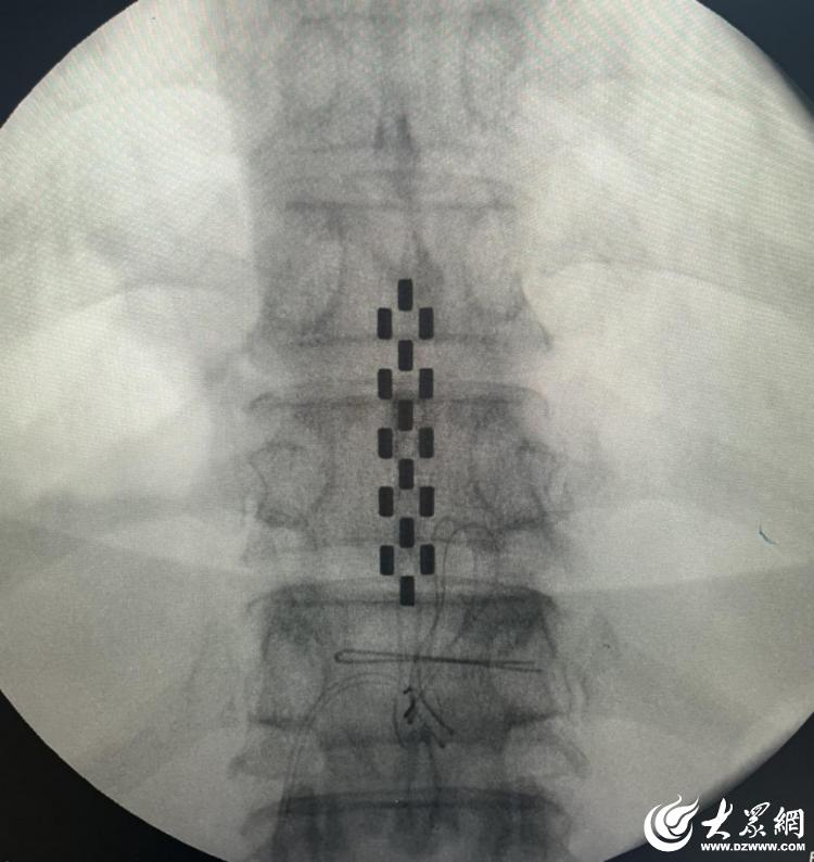 为神经“通电”！胜利油田中心医院脊髓电刺激术助脑卒中后偏瘫患者重获新生