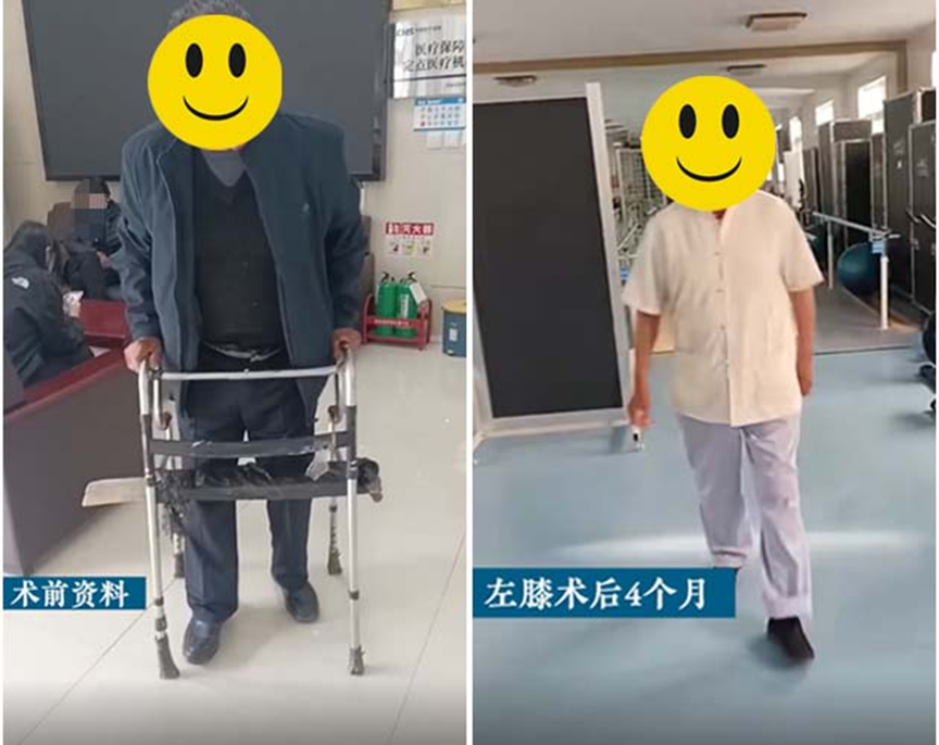 告别助行器！济南关节外科医院帮70岁大爷治好膝关节炎