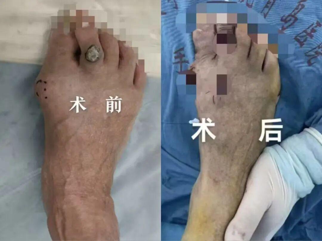 微创矫形 精准麻醉，拇外翻患者术后即可下地行走！
