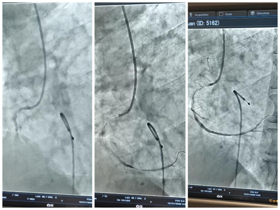 与死神抢人!1小时内,北大人民医院青岛医院胸痛中心救回心脏“三重暴击”工友生命!