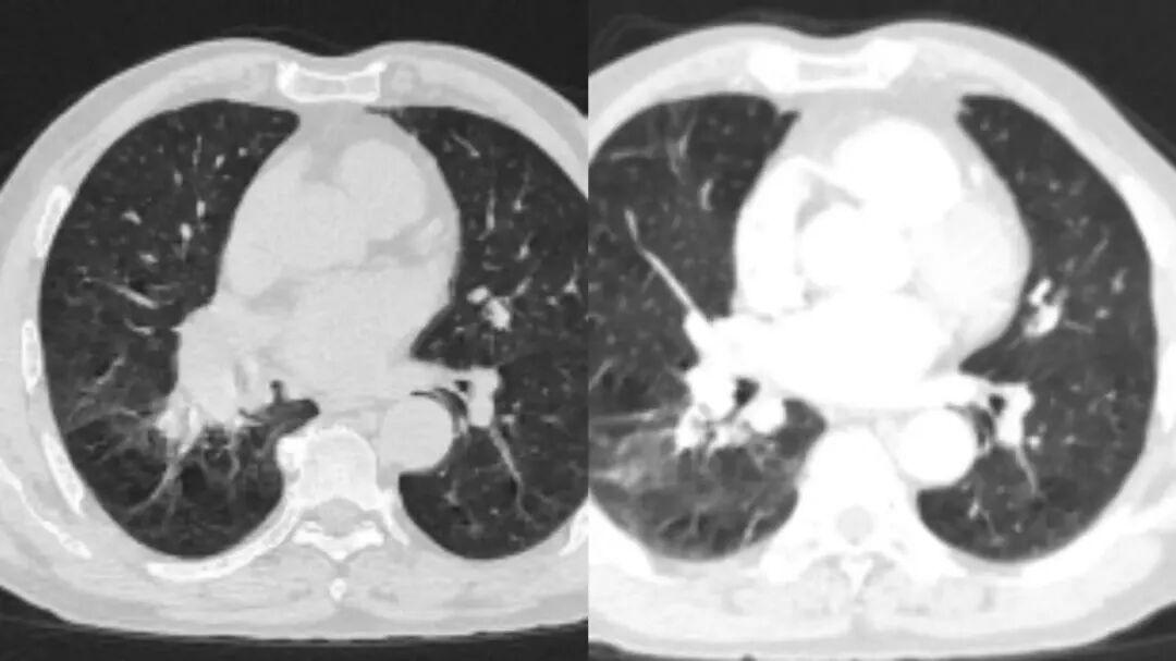 北京方案,青岛治疗!从难以手术到病理完全缓解,两位肺癌患者的绝地求生记