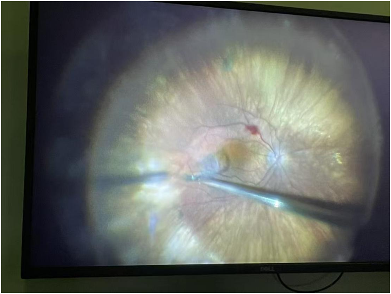 温医大眼视光,让德国患者放弃公费治疗赴温求医