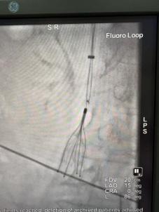 万名医护进乡村：烟台毓璜顶医院帮扶专家协助招远市人民医院完成首例高难度滤器取出术